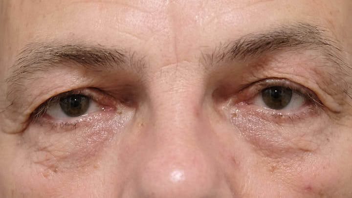 Augenlidzysten nach Laserbehandlung