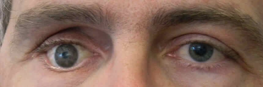 Augenlid-Rekonstruktion bei Patienten mit Augenprothesen