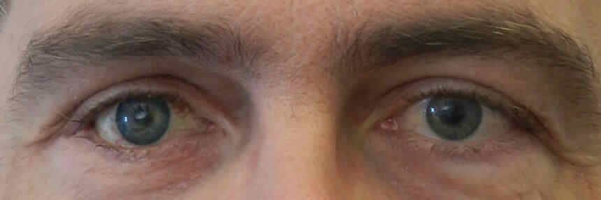 Augenlid-Rekonstruktion bei Patienten mit Augenprothesen